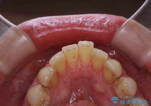 久しぶりの歯科医院にて歯のクリーニングの治療前