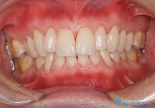 久しぶりの歯科医院にて歯のクリーニングの治療後