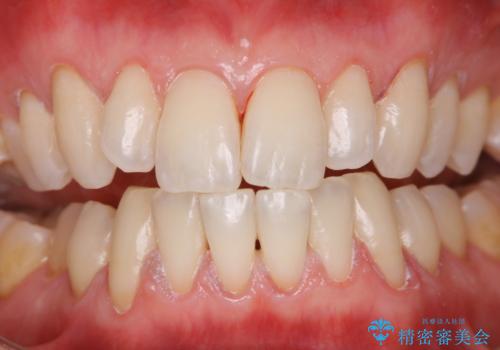 久しぶりの歯科医院にて歯のクリーニングの症例 治療後
