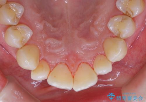 久しぶりの歯科医院にて歯のクリーニングの治療後