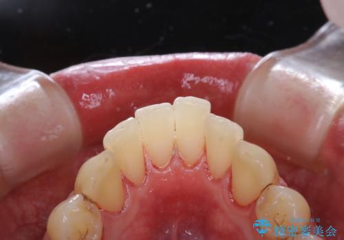 久しぶりの歯科医院にて歯のクリーニングの治療後