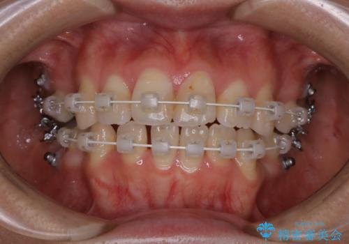 ワイヤー矯正中のPMTCの症例 治療前