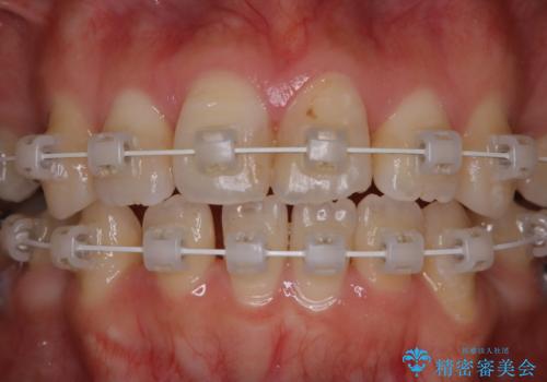 ワイヤー矯正中のPMTCの治療前