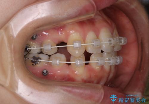 ワイヤー矯正中のPMTCの治療前
