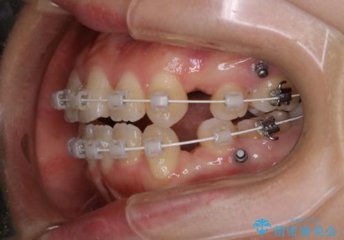 ワイヤー矯正中のPMTCの治療前