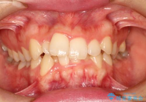 全体的ながたつき ワイヤーによる抜歯矯正で整った歯並びへ