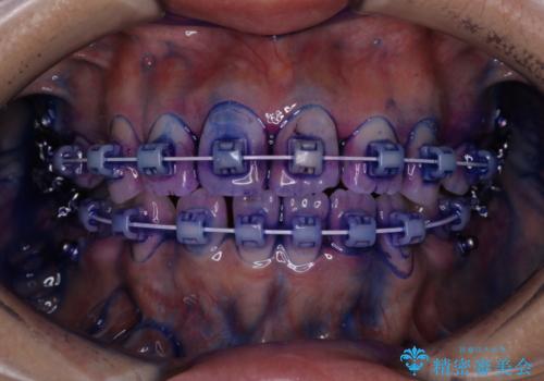 ワイヤー矯正中のPMTCの治療中
