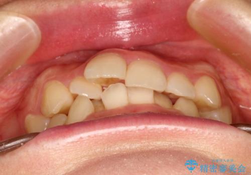 全体的ながたつき ワイヤーによる抜歯矯正で整った歯並びへの治療前