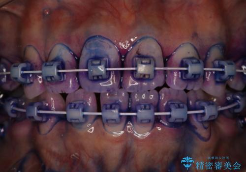 ワイヤー矯正中のPMTCの治療中