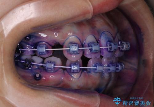 ワイヤー矯正中のPMTCの治療中