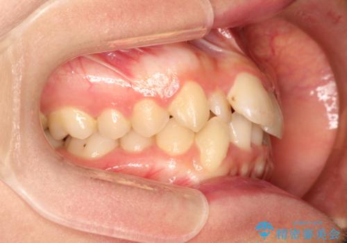 全体的ながたつき　ワイヤーによる抜歯矯正で整った歯並びへの治療前