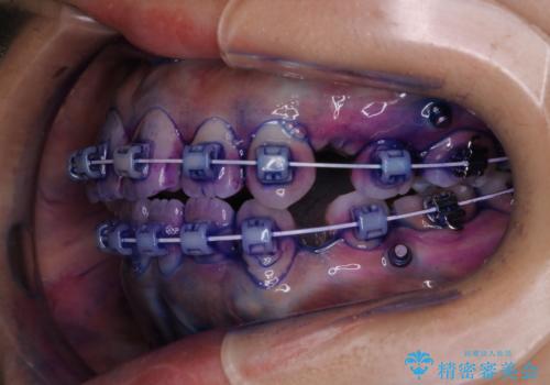 ワイヤー矯正中のPMTCの治療中