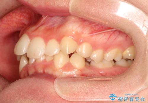 全体的ながたつき　ワイヤーによる抜歯矯正で整った歯並びへの治療前