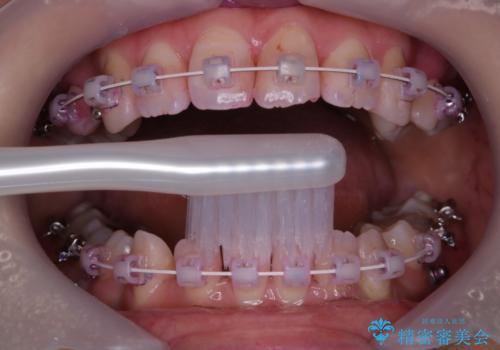 ワイヤー矯正中のPMTCの治療前