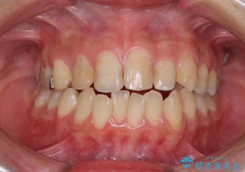 後戻りを治したい 骨格的なズレの大きい方のインビザライン矯正の症例 治療前