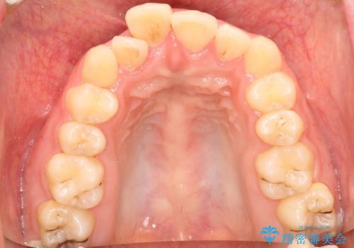 全体的ながたつき ワイヤーによる抜歯矯正で整った歯並びへの治療前