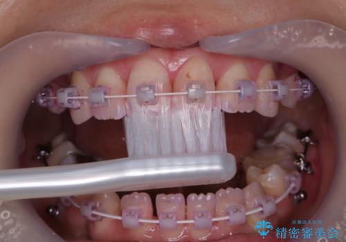 ワイヤー矯正中のPMTCの治療中
