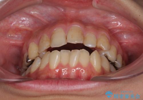 後戻りを治したい 骨格的なズレの大きい方のインビザライン矯正の治療前
