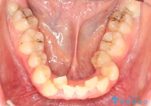 全体的ながたつき ワイヤーによる抜歯矯正で整った歯並びへの治療前