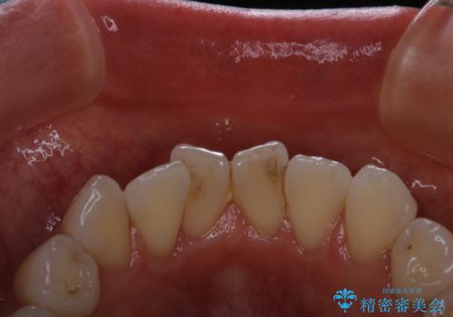 前歯の裏側の着色落としをPMTCでキレイにの治療前