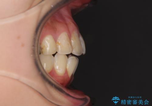 後戻りを治したい 骨格的なズレの大きい方のインビザライン矯正の治療前