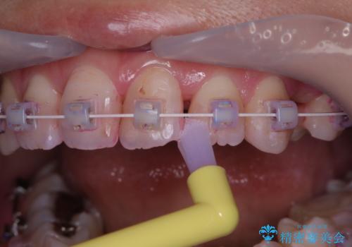 ワイヤー矯正中のPMTCの治療後