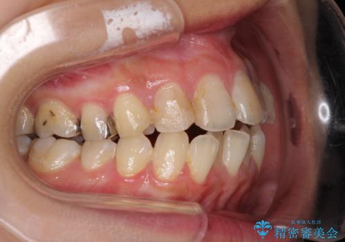 後戻りを治したい 骨格的なズレの大きい方のインビザライン矯正の治療前