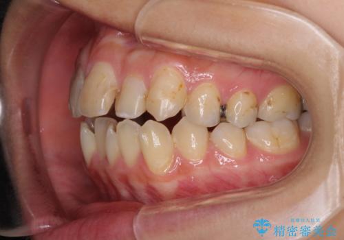 後戻りを治したい 骨格的なズレの大きい方のインビザライン矯正の治療前