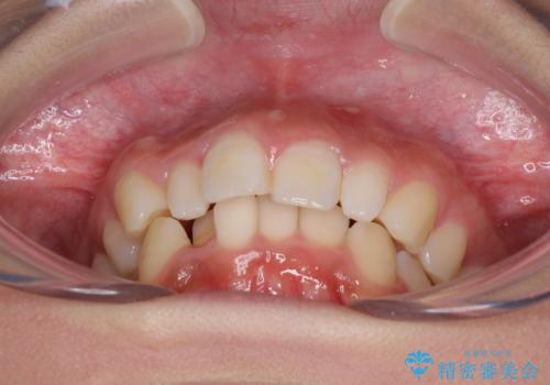 前歯のデコボコを治したい インビザラインによる矯正治療の治療前