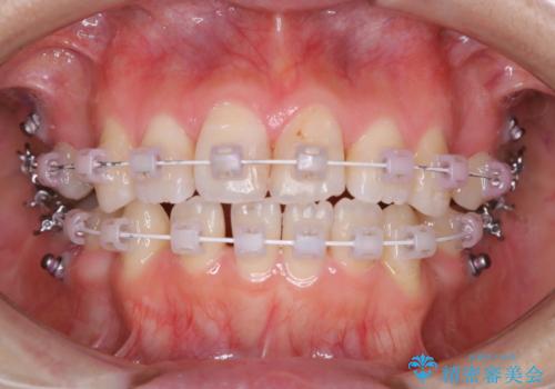 ワイヤー矯正中のPMTCの症例 治療後