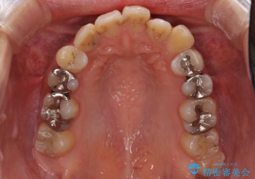 後戻りを治したい 骨格的なズレの大きい方のインビザライン矯正の治療前