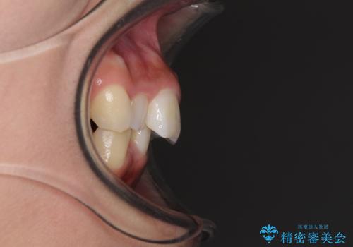 前歯のデコボコを治したい インビザラインによる矯正治療の治療前