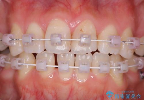 ワイヤー矯正中のPMTCの治療後