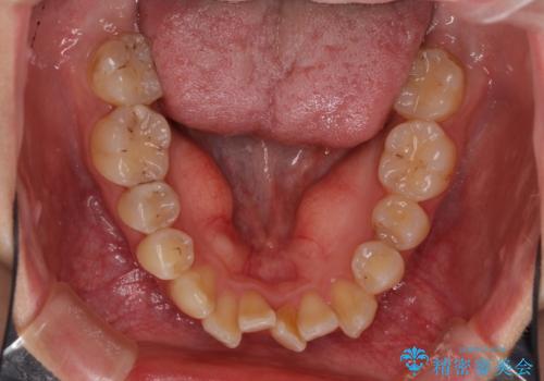 後戻りを治したい 骨格的なズレの大きい方のインビザライン矯正の治療前