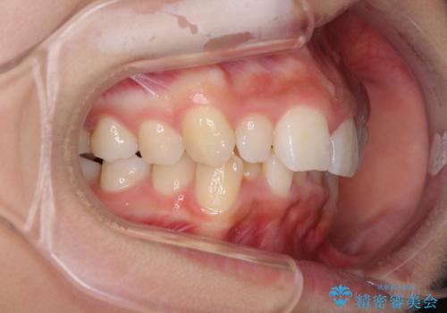 前歯のデコボコを治したい インビザラインによる矯正治療の治療前