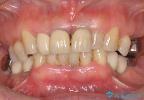 前歯が抜けそう ブリッジできれいに 70代女性の治療前