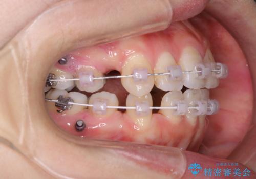 ワイヤー矯正中のPMTCの治療後