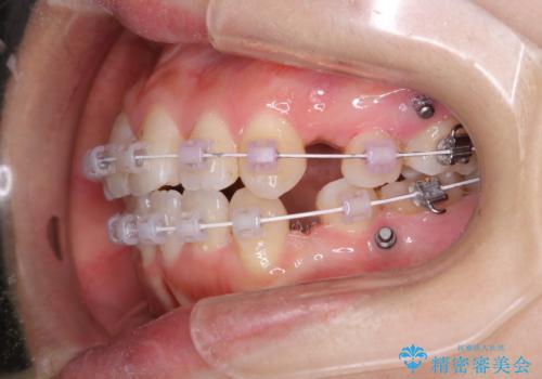 ワイヤー矯正中のPMTCの治療後