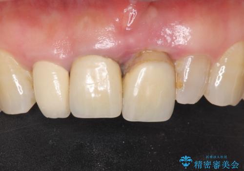 前歯が抜けそう ブリッジできれいに 70代女性の治療前