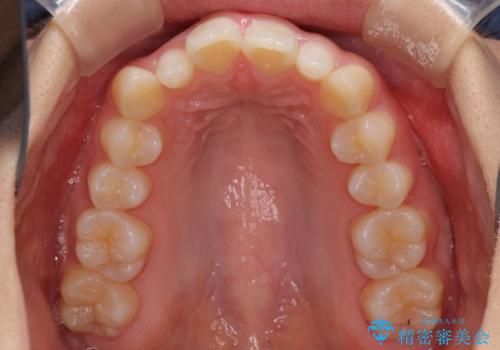 前歯のデコボコを治したい インビザラインによる矯正治療の治療前