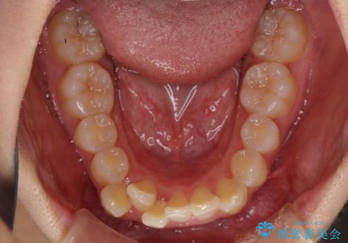 前歯のデコボコを治したい インビザラインによる矯正治療の治療前