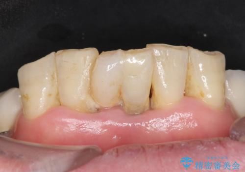 前歯が抜けそう ブリッジできれいに 70代女性の治療前