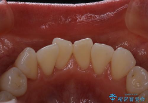 前歯の裏側の着色落としをPMTCでキレイにの治療後