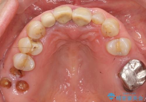 前歯が抜けそう ブリッジできれいに 70代女性の治療前