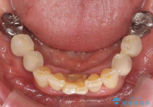 前歯が抜けそう ブリッジできれいに 70代女性の治療前