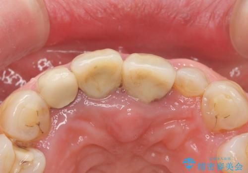 前歯が抜けそう ブリッジできれいに 70代女性の治療前