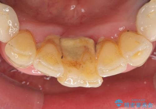 前歯が抜けそう ブリッジできれいに 70代女性の治療前