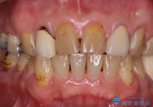 統一感のない前歯を綺麗にしたい　前歯のオールセラミックの治療前