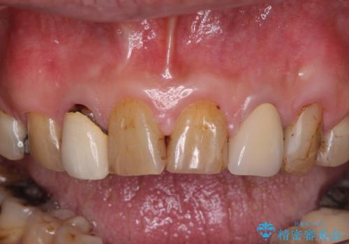 統一感のない前歯を綺麗にしたい　前歯のオールセラミックの治療前