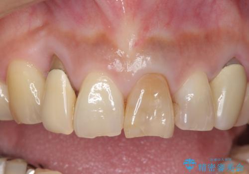 オールセラミッククラウン　下がってしまった前歯の歯茎の改善の治療前